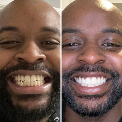 Instant-Brighten Whitening Strips™