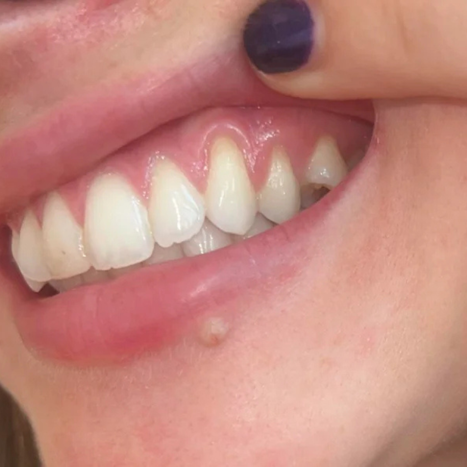Restore Receding Gums